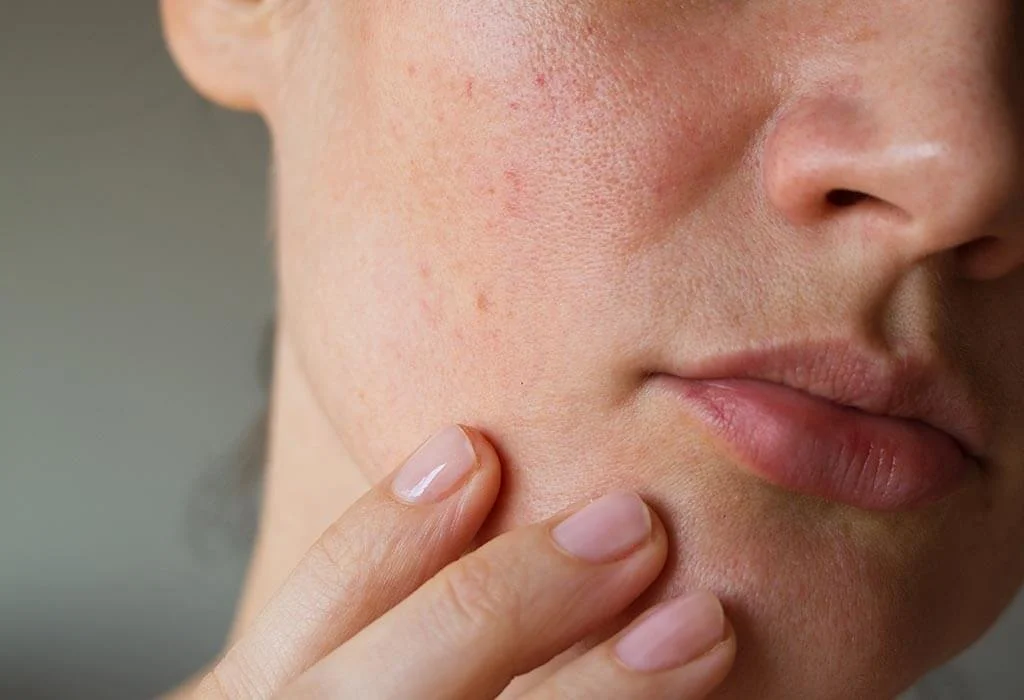Green Tea Helps Reduce Pores on the Skin