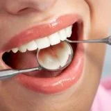 Dental Fillings1