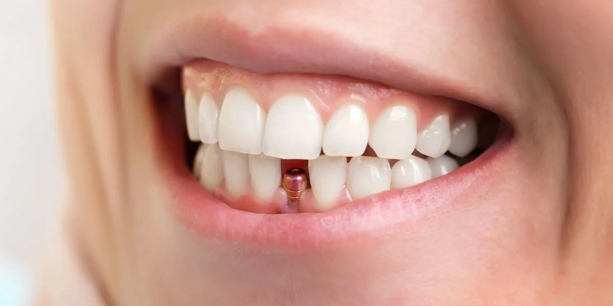 Dental Implants 1
