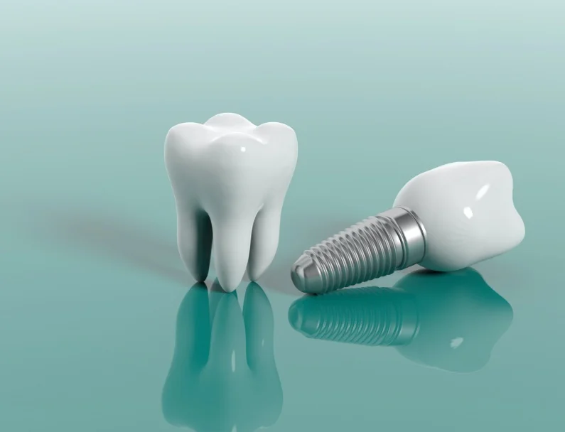 Dental Implants 2
