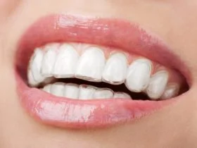 Invisalign 1
