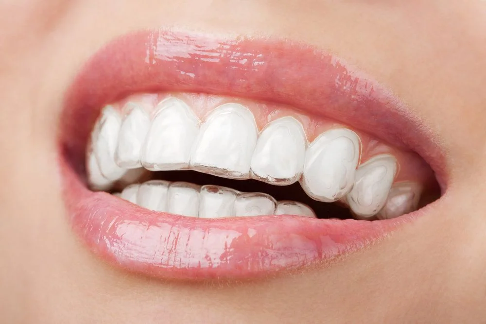 Invisalign 1